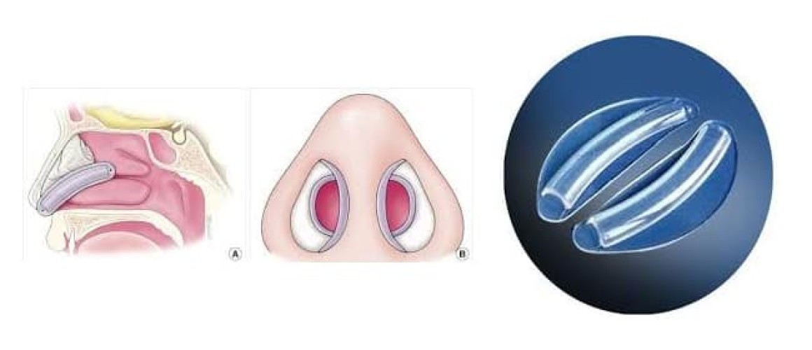 rinoplastica senza tamponi